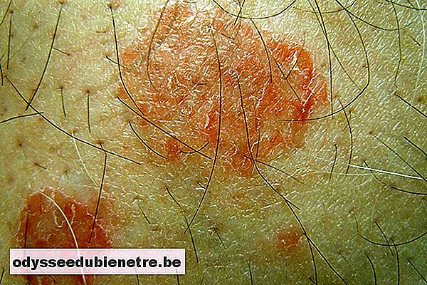 O que é dermatite numular e principais sintomas