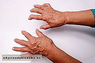 Sinais de deformidade devido artrite reumatoide