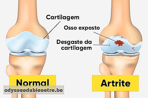 Como saber se é artrite