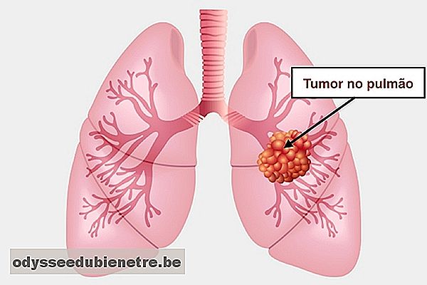 Sintomas de câncer de pulmão