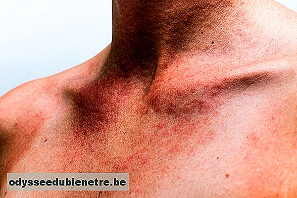 Como identificar e tratar a Alergia na pele