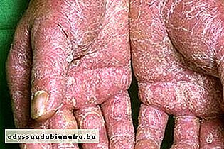 Eczema nas mãos grave 