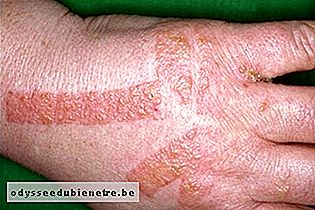 Dermatite de contato após uso de tape