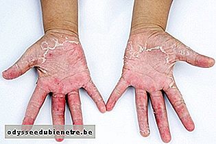 Dermatite de contato com sinais de infecção nos dedos 