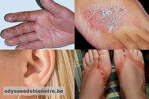 O que é Dermatite de Contato e como Tratar