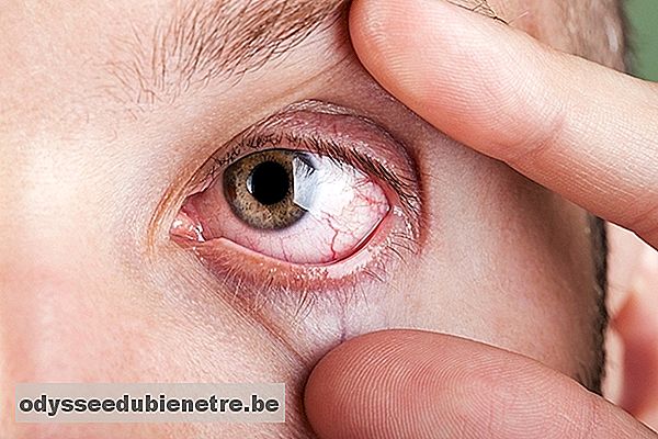 Sabia que a Artrite Reumatoide pode afetar os olhos?