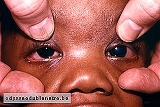 Causas e tratamento do Glaucoma no Bebê