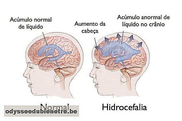 Hidrocefalia na Infância - Tipos, Sintomas e Tratamento