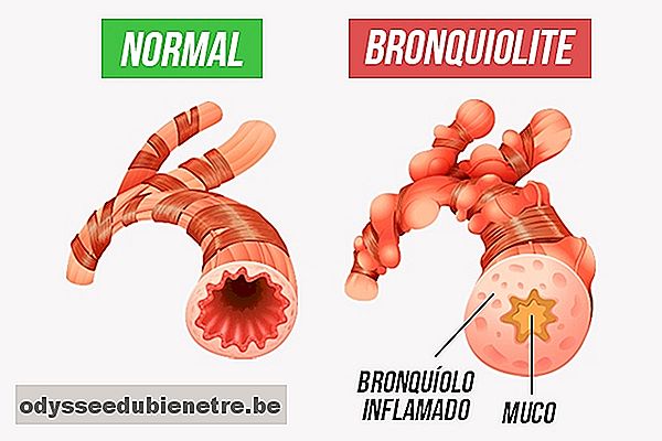 Como identificar e evitar a bronquiolite