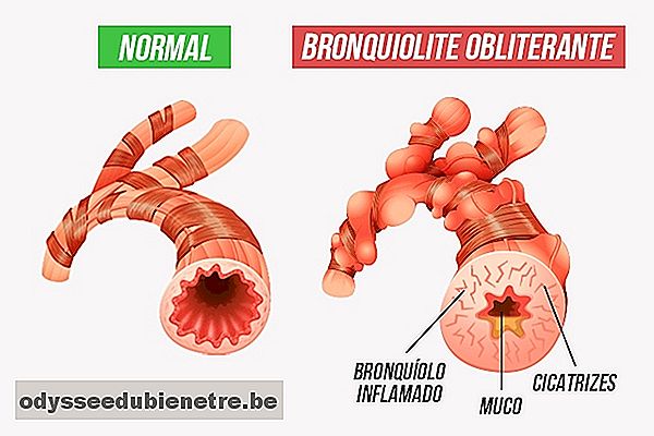 Como identificar e tratar a bronquiolite obliterante
