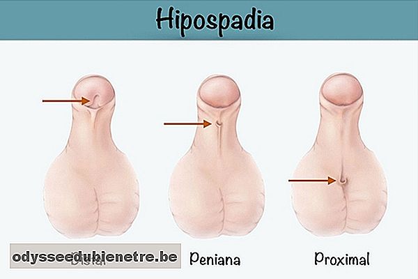 Hipospádia - urina que sai por baixo do pênis do bebê