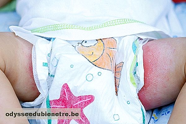 Problemas de pele mais comuns no bebê