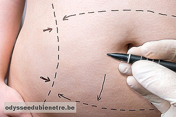 Abdominoplastia completa