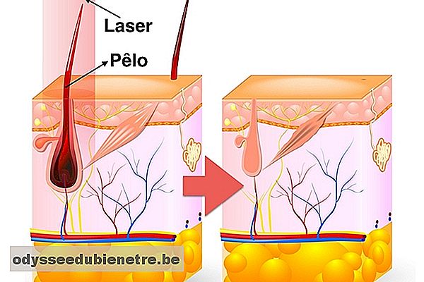 Como funciona a depilação a laser