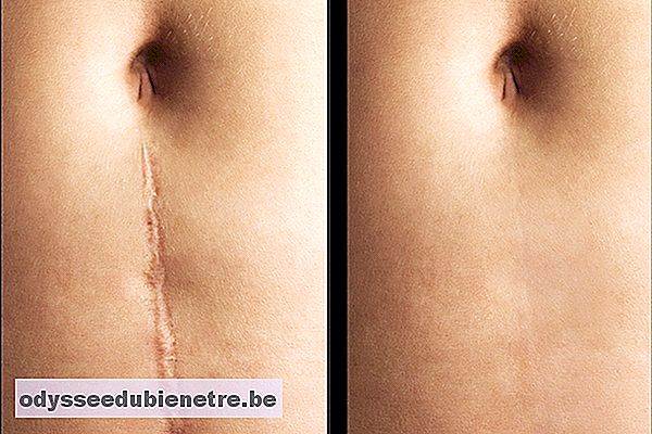 Antes e depois da cirurgia para corrigir cicatriz