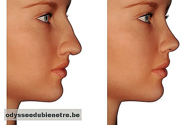 Cirurgia no nariz pode melhorar a auto-estima e a respiração