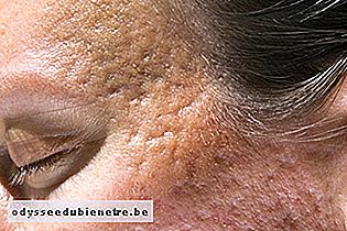 Tratamentos para tirar Cicatriz de Acne do rosto