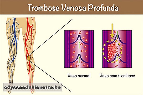 Sintomas de Trombose