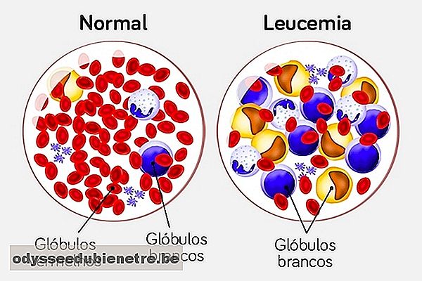 Entenda a diferença entre Leucemia mieloide e Leucemia linfoide