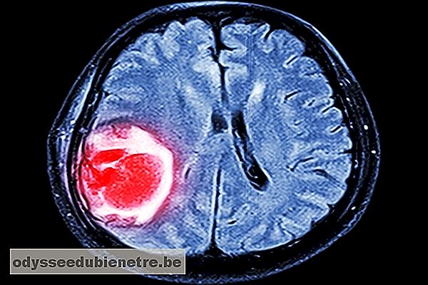 Tratamentul cu glioblastom: Cum tratează medicii această tumoră cerebrală? - Healths - 