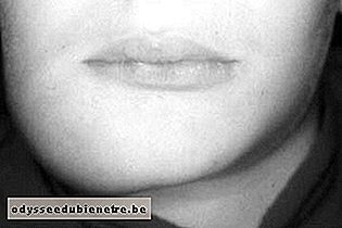 Sintoma de Linfoma de Burkitt - Inchaço da face