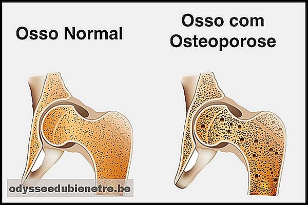 Entenda o que é Osteoporose e suas Causas