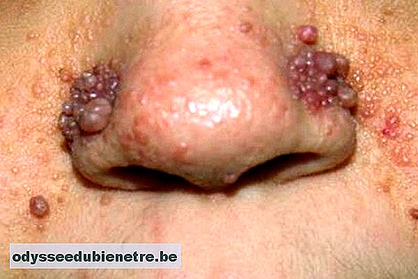 Lesões na pele características da Esclerose Tuberosa