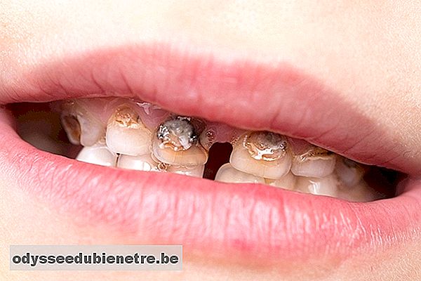 Como tratar a hipoplasia do esmalte dentário