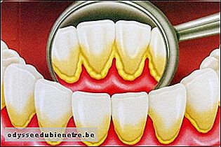 Tártaro nos dentes - placa bacteriana