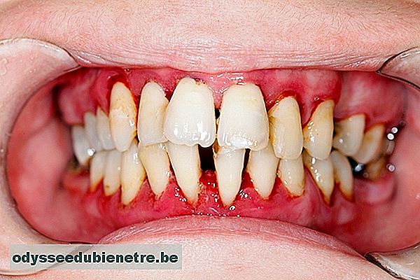 Dentes moles e separados podem indicar Doença