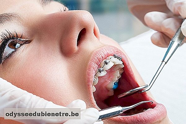 Tipos de má oclusão dentária e como tratar