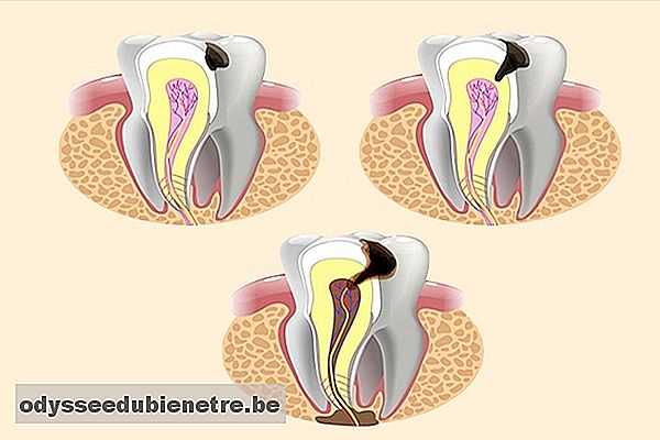 Cárie causando inflamação da polpa do dente