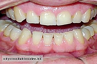 Desgaste da superfície dos dentes