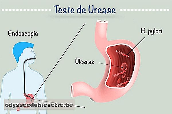 Teste da Urease detecta H. pylori no estômago
