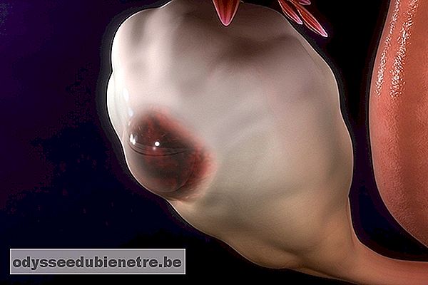 Endometriose no ovário: Sintomas e Tratamento