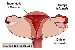 Trompa uterina inflamada