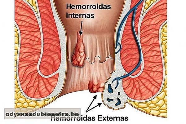 4 opções de Tratamentos para Hemorroidas Externas