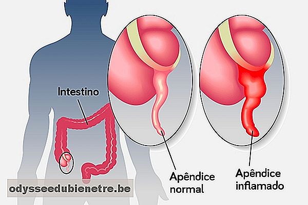 Apendicite: o que é, sintomas e como identificar