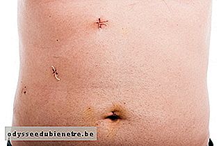Cicatriz de apendicetomia por laparoscopia