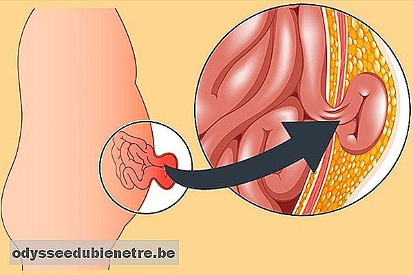 Como identificar e tratar a hérnia abdominal