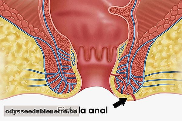 O que é fístula anal e como tratar