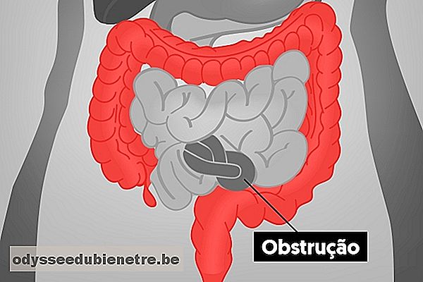 O que é a Obstrução intestinal e como tratar