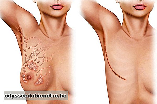 5 tipos principais de mastectomia e como são feitos