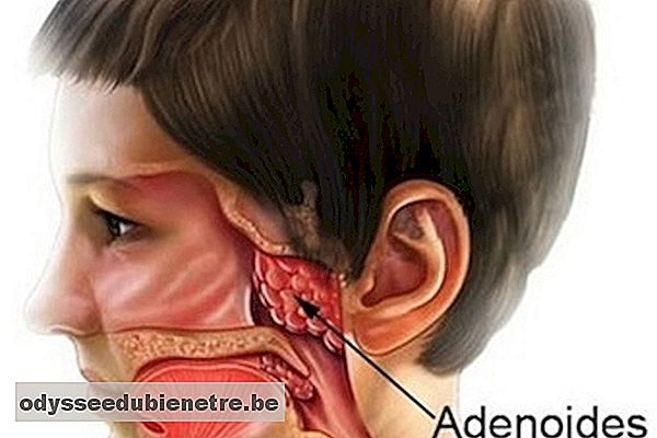 Cirurgia de adenoide