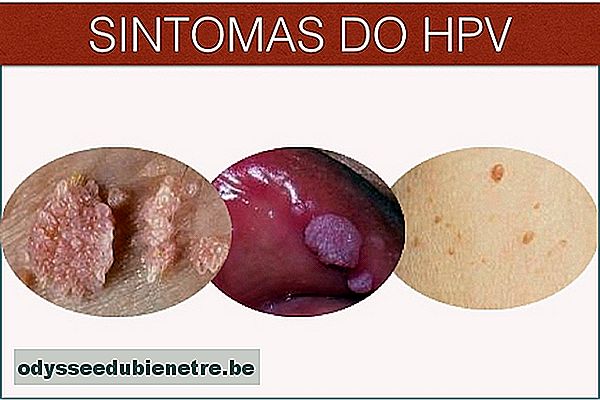Pomada de Barbatimão pode ser a cura do HPV
