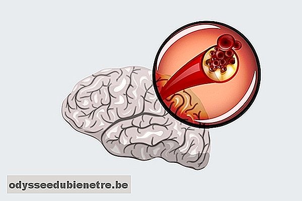 Isquemia cerebral: o que é, principais e sintomas e possíveis sequelas