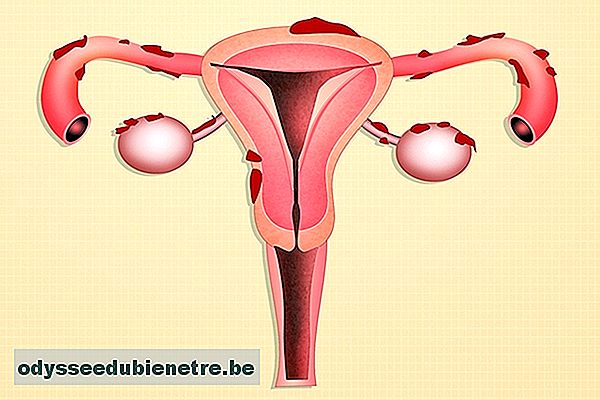Esclareça todas as Dúvidas sobre a Endometriose