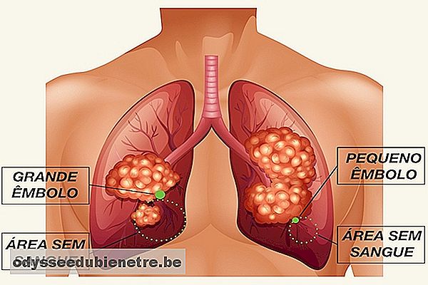 Consequências da Embolia Pulmonar