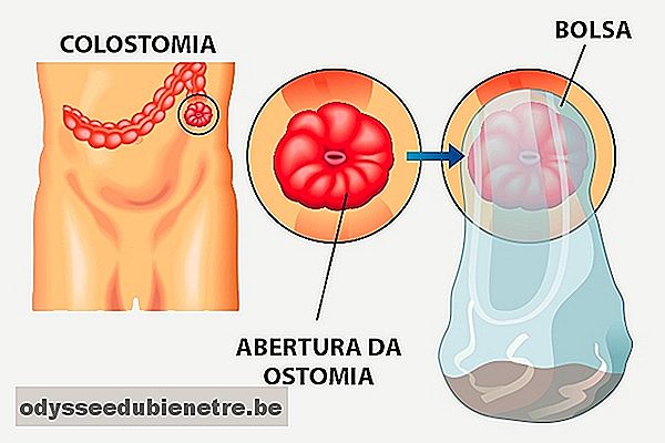 Como cuidar da colostomia e ileostomia