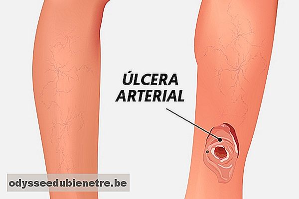 Como tratar uma úlcera arterial